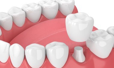 Dental Veneers vs Dental Crowns: Understanding Which Treatment Is Right for Your Smile