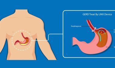 Barrett's Esophagus Specialists: Expert Care for Early Diagnosis and Effective Treatment