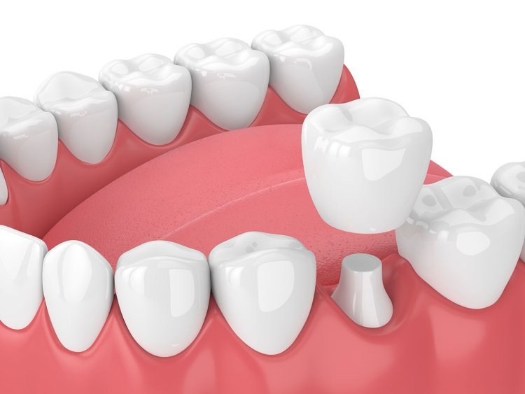 Dental Veneers vs Dental Crowns: Understanding Which Treatment Is Right for Your Smile