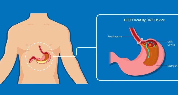 Barrett's Esophagus Specialists: Expert Care for Early Diagnosis and Effective Treatment